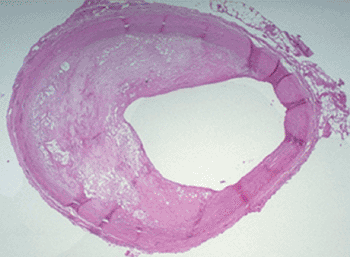 Image: Histology of an atherosclerotic plaque (Photo courtesy of Boston University).